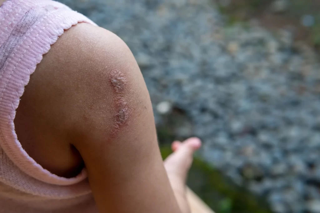 Shutterstock_2295060825 - SportDeník Dítě s bakteriálním onemocněním kůže impetigo