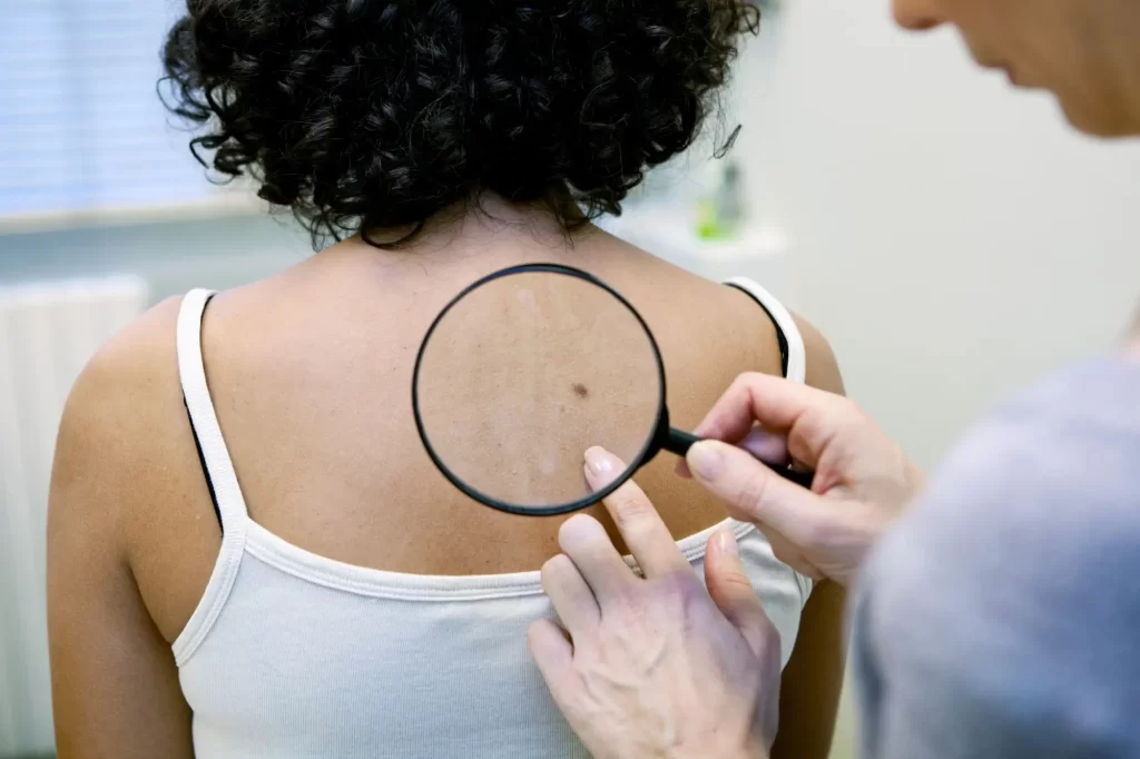 - SportDeník Dermatolog vyšetřuje znaménko na zádech pacienta