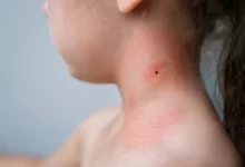 klíště