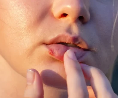 Opar je způsoben infekcí virem s názvem Herpes simplex, zkráceně HSV. Zdroj žena má na puse opar