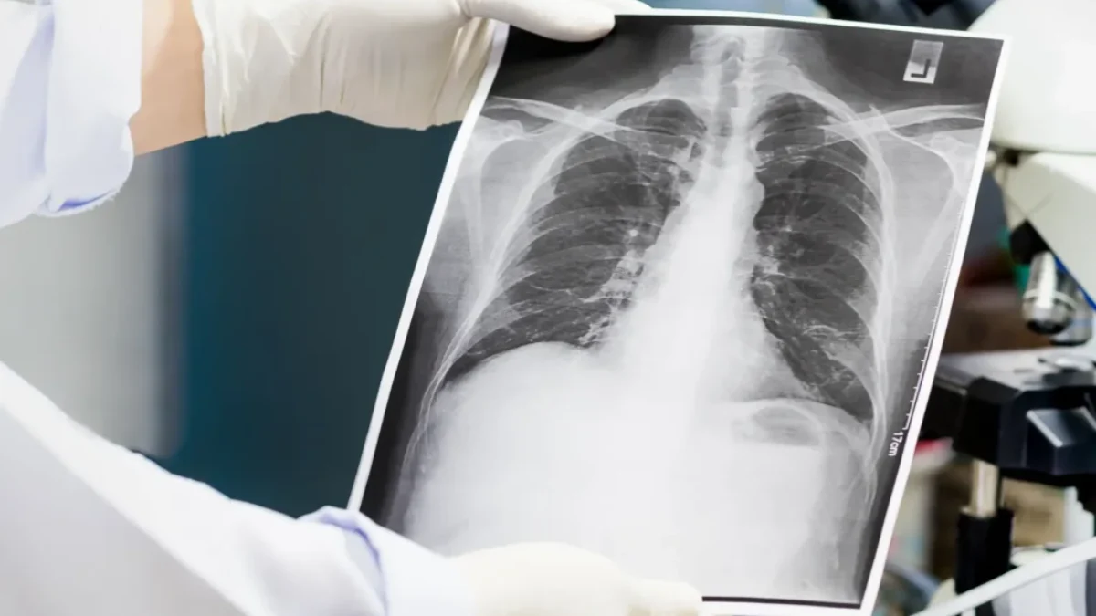 rentgenový snímek plic