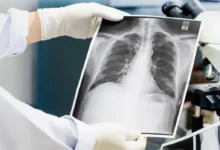 rentgenový snímek plic